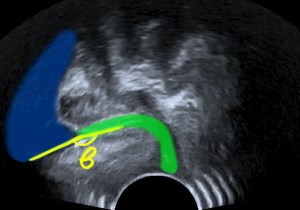 open retrovesical angle beta