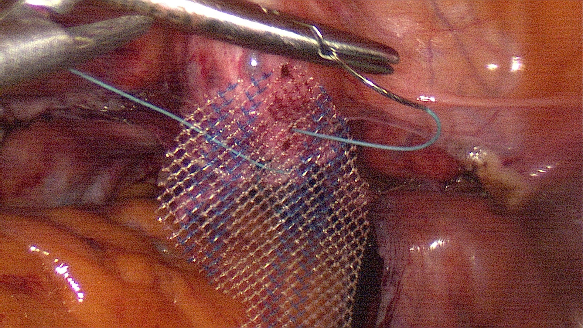 sacrocervicopexy laparoscopy