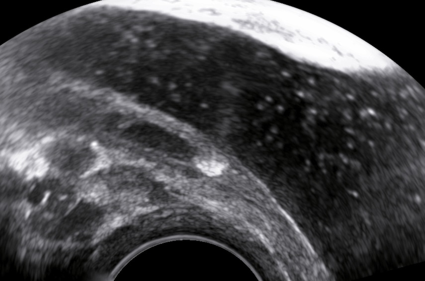 Ureterolithiasis in Pregnancy