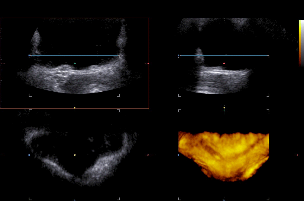 Ureterolithiasis in pregnancy 3d