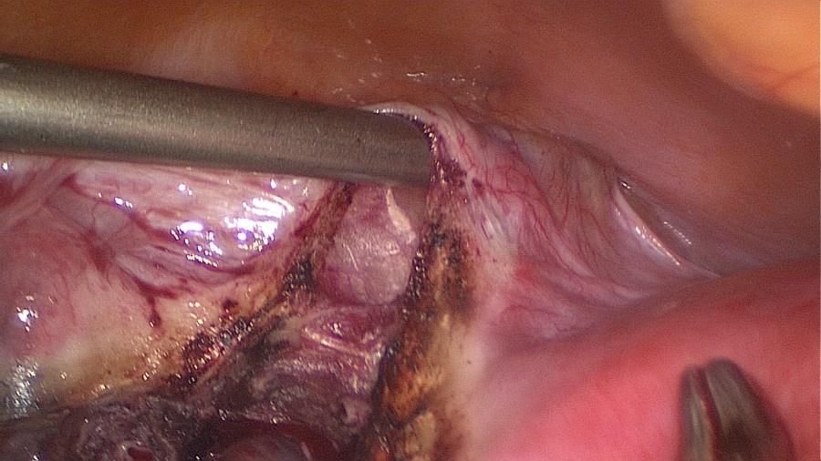 Total Laparoscopic Hysterectomy (TLH)