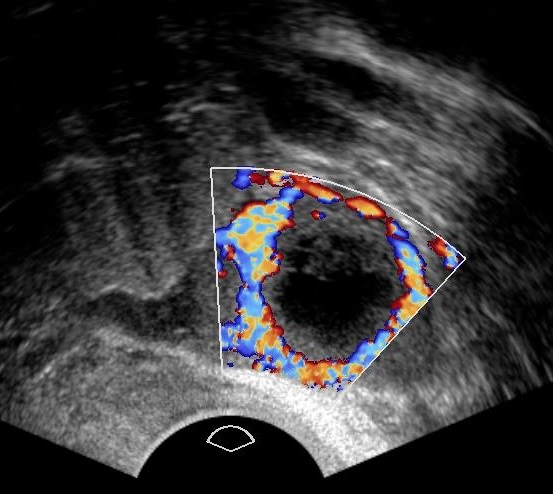 Color doppler of a corpus luteum graviditatis.
