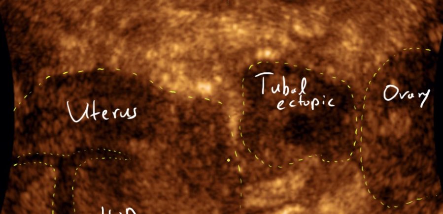 Ultrasound of ectopic pregnancy