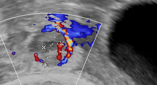Color doppler of the same ectopic.