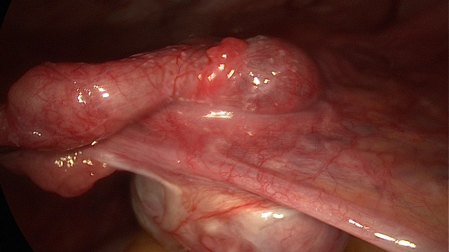 Laparoscopic Management of Tubal Ectopic Pregnancy #2 Salpingectomy