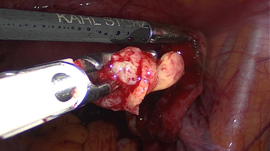 Laparoscopic Management of Tubal Ectopic Pregnancy #1 Salpingotomy