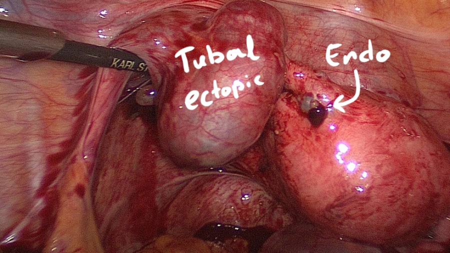 Ectopic Pregnancy Series