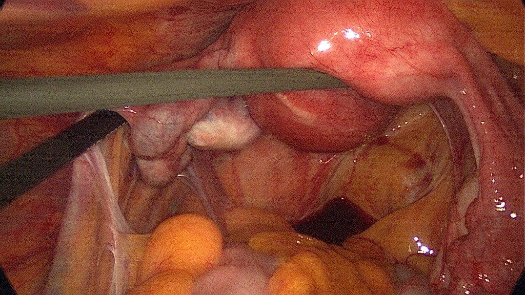 ectopic pregnancy chlamydia