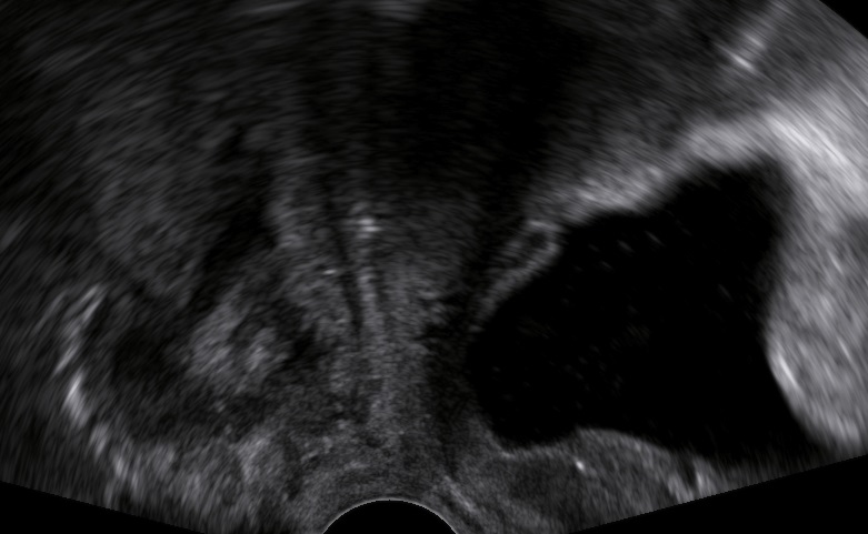 Pelvic Floor Ultrasound: The Cystocele