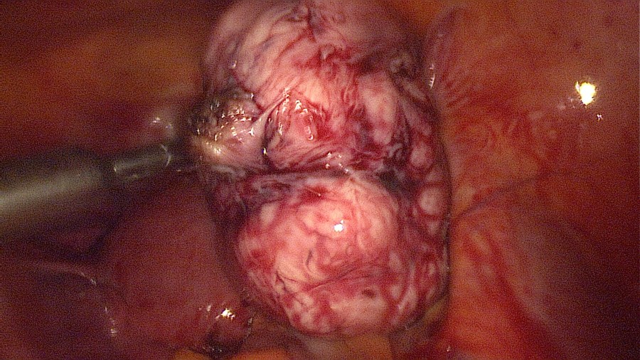 Laparoscopic Myomectomy