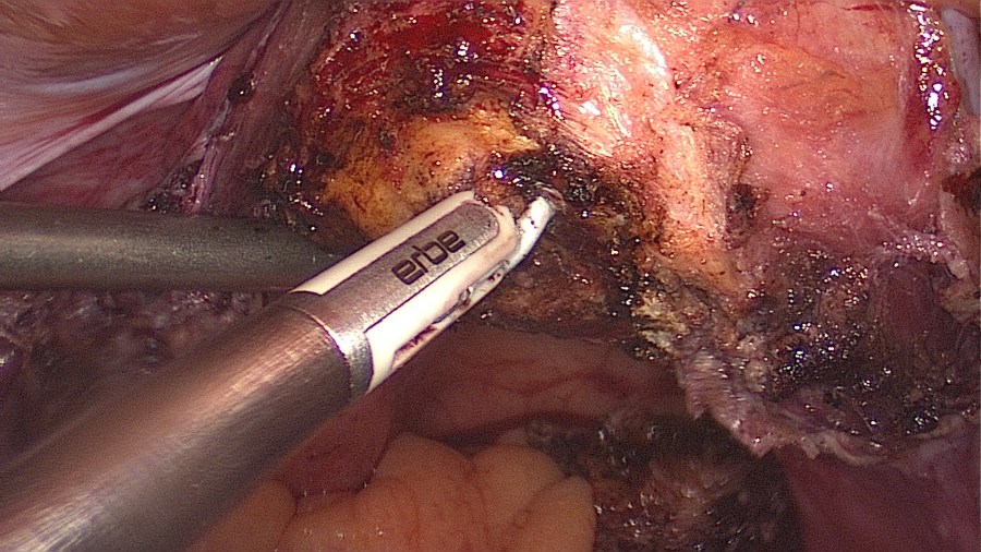 LAparoscopic Supracervical Hysterectomy (LASH)