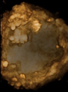 Endometrial cancer 3d ultrasound