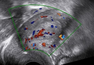 endometrial cancer doppler ultrasound