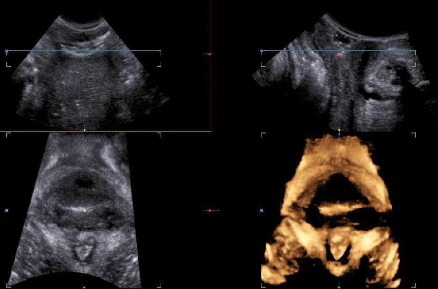 Levator ani muscle injury 3d gif