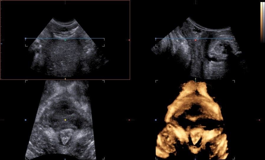 Levator Ani Avulsion