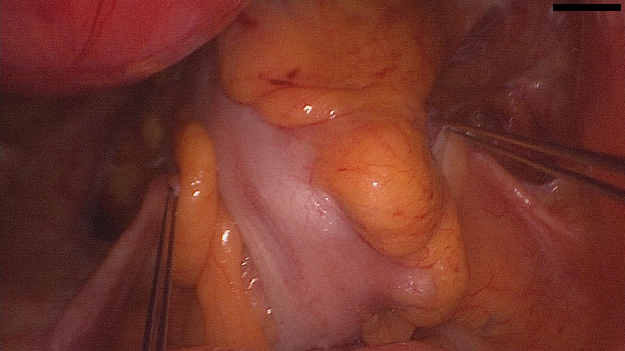 vNOTES USL Suspension