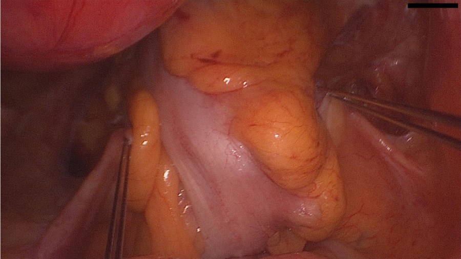 vNotes Uterosacral Ligament Suspension