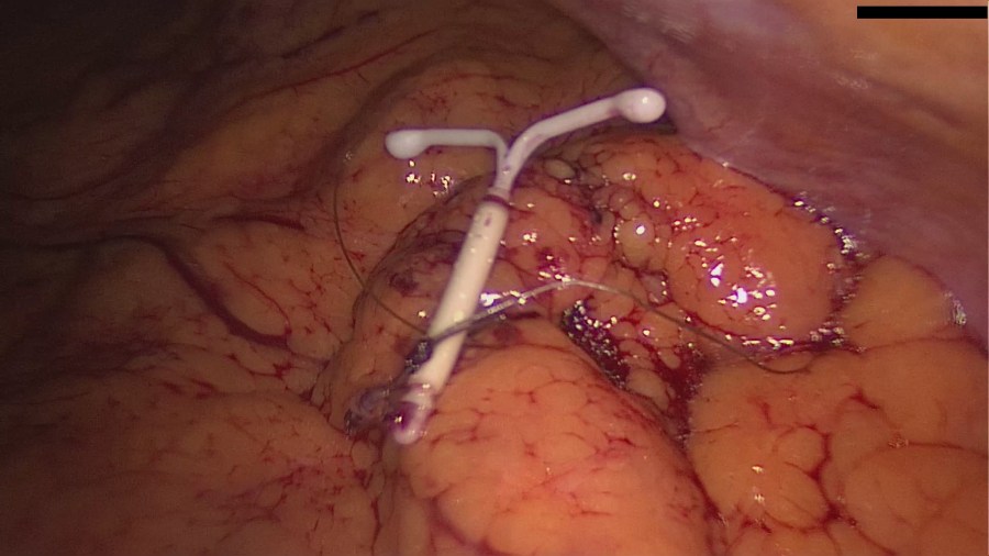 Laparoscopic Removal of an intraabdominal IUD