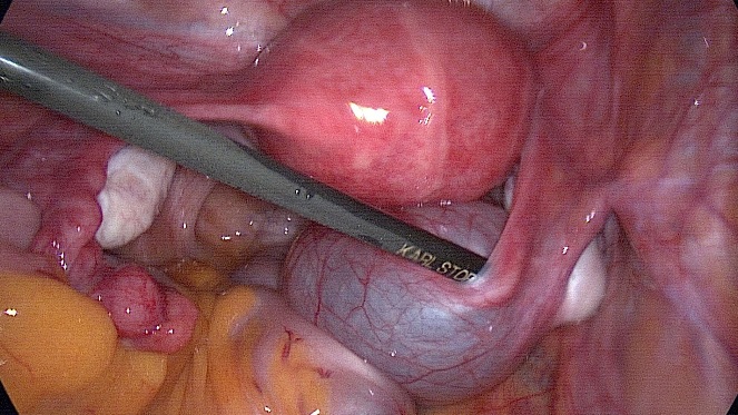 Paraovarian / Paratubal Cyst