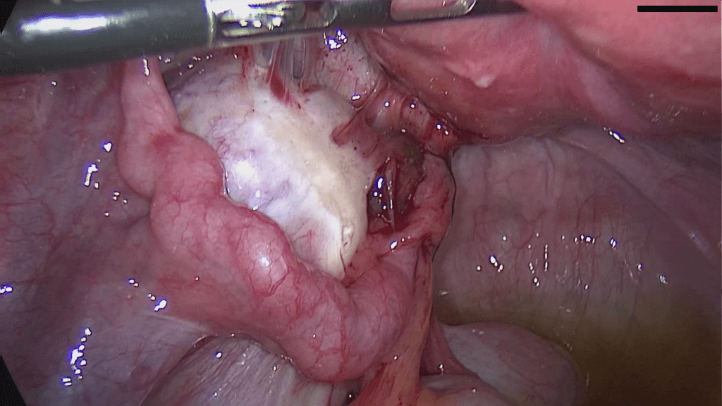 Chronic ectopic pregnancy laparoscopy