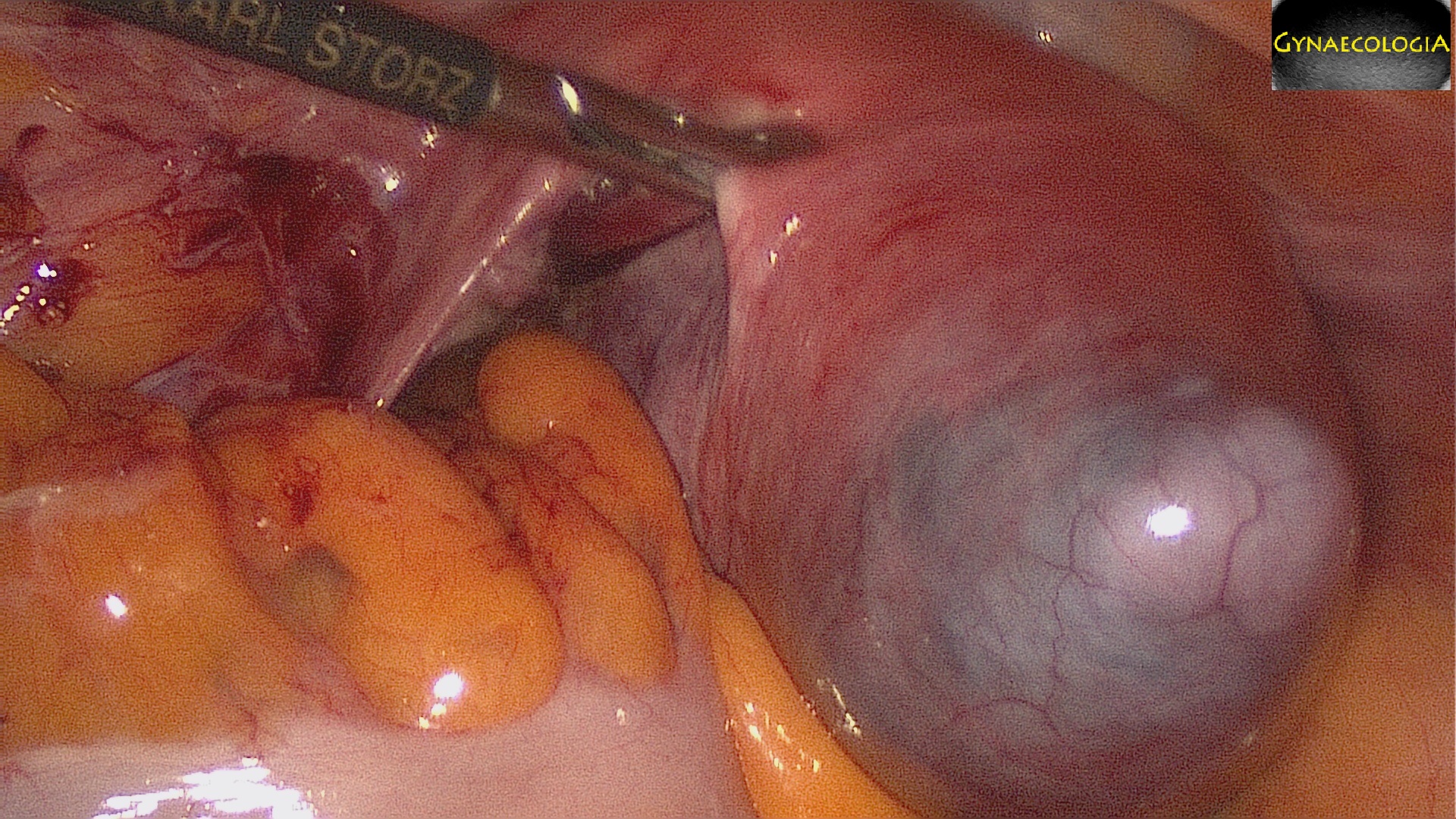 Mesothelial Cyst of the Uterus