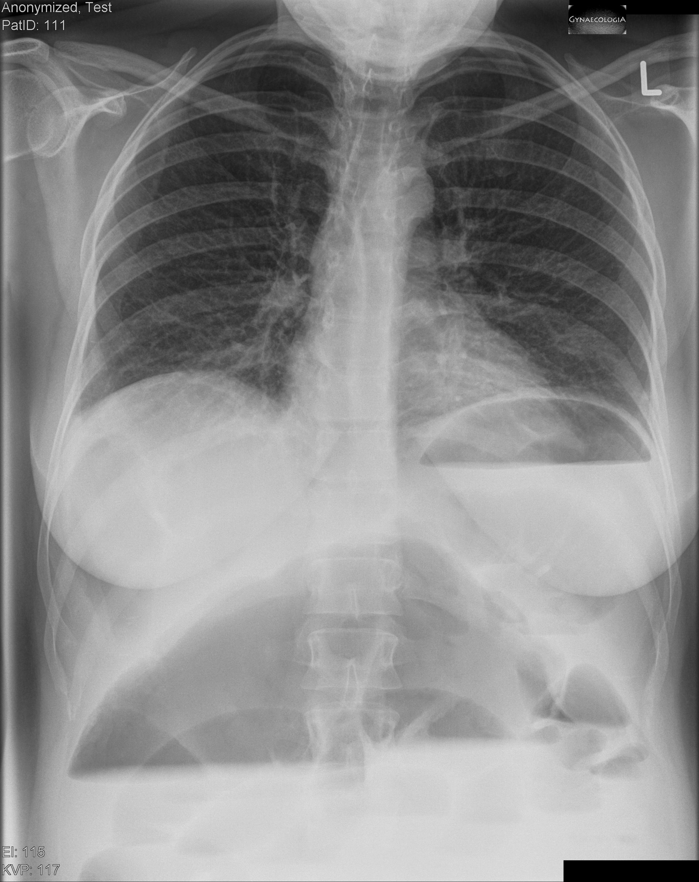 volvulus in pregnancy