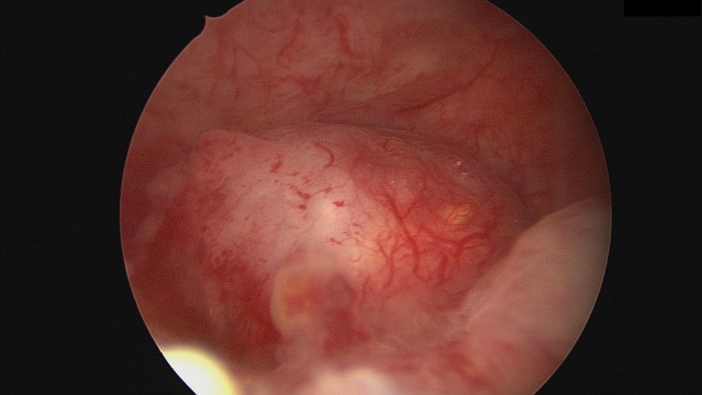 Myoma FIGO II Fibroid Hysteroscopy