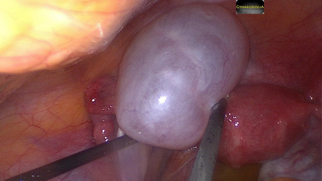mucinous cystadenoma laparoscopy
