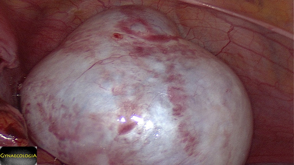 mucinous cystadenoma treatment