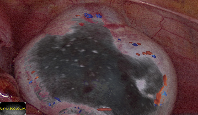 Mucinous Cystadenoma