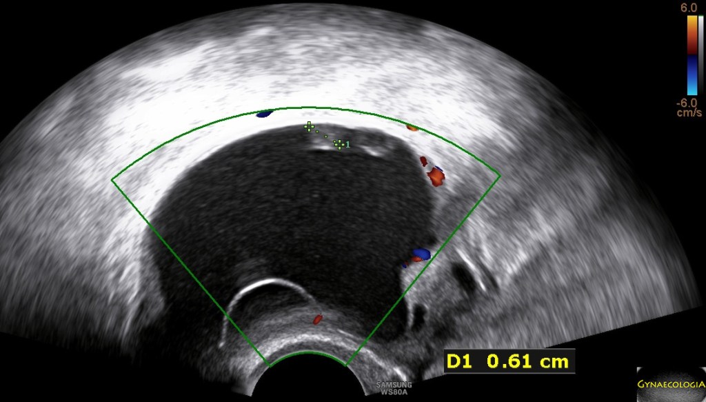 Mucinous cystadenoma mural nodules