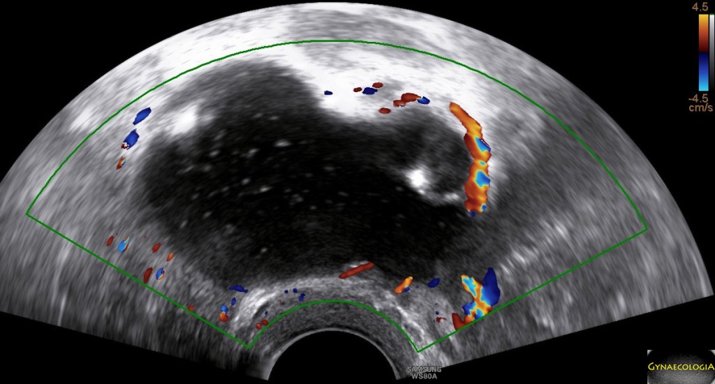 mucinous cystadenoma ultrasound