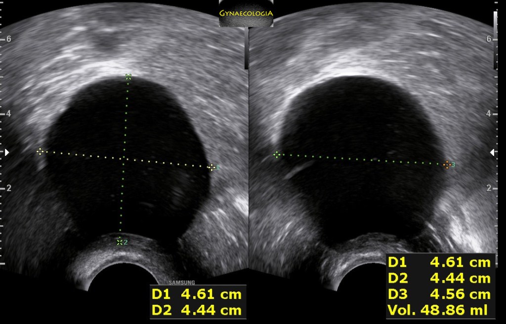 mucinous cystadenoma echogenicity
