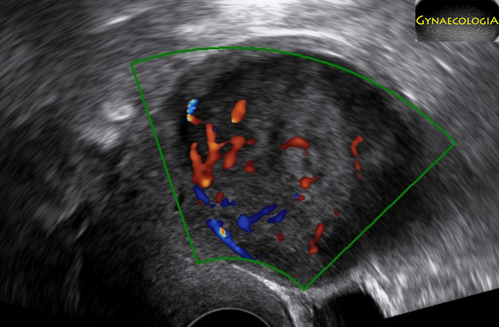 Smooth Muscle Tumor of Uncertain Malignant Potential (STUMP)