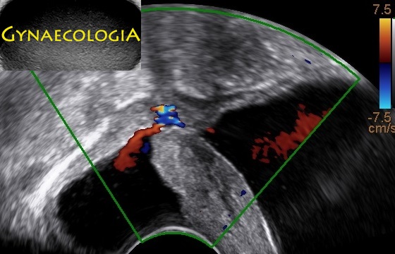 vesicovaginal fistula ultrasound