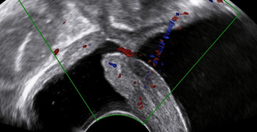 Vesicovaginal fistula after hysterectomy