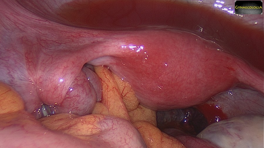 Fallopian Tube Torsion