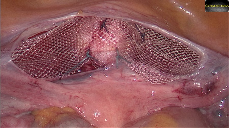 Laparoscopic Lateral Suspension (Dubuisson)