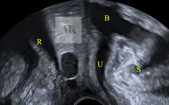 Vaginal Inclusion Cyst
